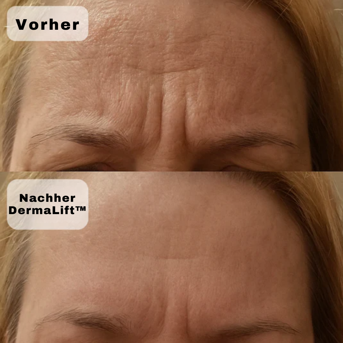 DermaLift™ Night Patches